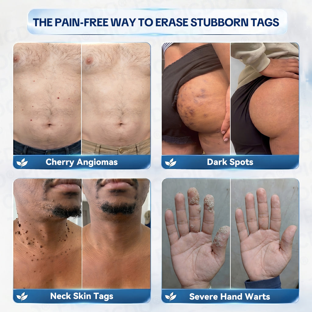 𝐏𝐡𝐚𝐫𝐦𝐚𝐜𝐢𝐬𝐭 𝐑𝐞𝐜𝐨𝐦𝐦𝐞𝐧𝐝𝐞𝐝👨🏻‍⚕️𝐏𝐢𝐜𝐝𝐨® 7-𝐃𝐚𝐲 𝐒𝐤𝐢𝐧 𝐓𝐚𝐠 & 𝐒𝐩𝐨𝐭 𝐄𝐫𝐚𝐬𝐞𝐫 𝐂𝐫𝐞𝐚𝐦 🍀(Zero Pain, Zero 𝐒𝐜𝐚𝐫𝐬 Formula)