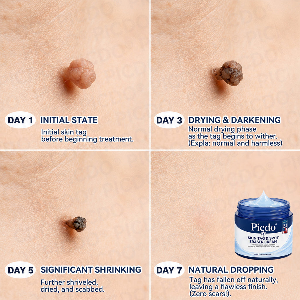 𝐏𝐡𝐚𝐫𝐦𝐚𝐜𝐢𝐬𝐭 𝐑𝐞𝐜𝐨𝐦𝐦𝐞𝐧𝐝𝐞𝐝👨🏻‍⚕️𝐏𝐢𝐜𝐝𝐨® 7-𝐃𝐚𝐲 𝐒𝐤𝐢𝐧 𝐓𝐚𝐠 & 𝐒𝐩𝐨𝐭 𝐄𝐫𝐚𝐬𝐞𝐫 𝐂𝐫𝐞𝐚𝐦 🍀(Zero Pain, Zero 𝐒𝐜𝐚𝐫𝐬 Formula)